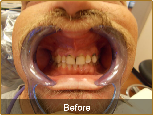 deep cleaning of teeth before and after